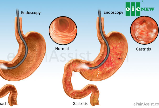 upload/files/DA_DAY/2GASTRITIS.jpg