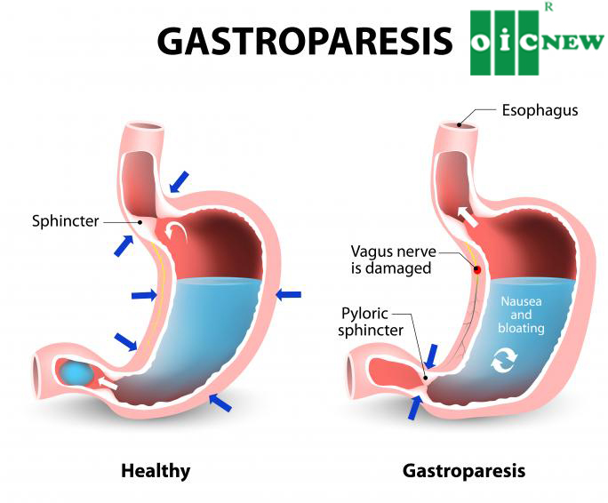 upload/files/DA_DAY/a-diagram-showing-two-stomachs-representing-the-effects-of-gastroparesis.jpg