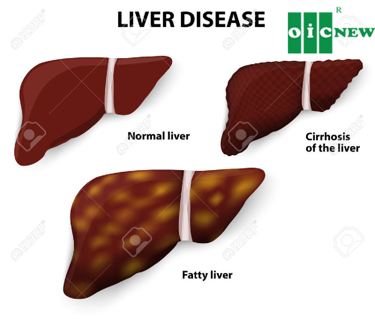 upload/files/GAN_MAT/29114856-Liver-Disease-Cirrhosis-of-the-liver-Fatty-liver-and-Normal-liver-Stock-Vector(1).jpg