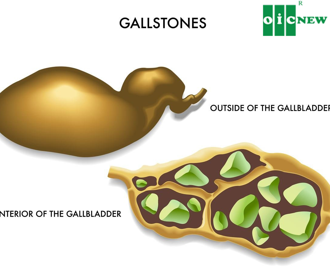 upload/files/GAN_MAT/Gallstones.jpg