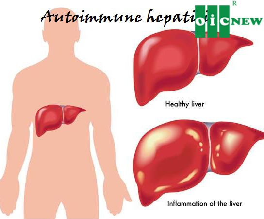 upload/files/GAN_MAT/autoimmune-hepatitis-versus-normal-liver-2013.jpg