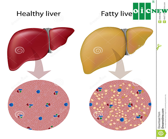 upload/files/GAN_MAT/fatty-liver-disease-29095488.png