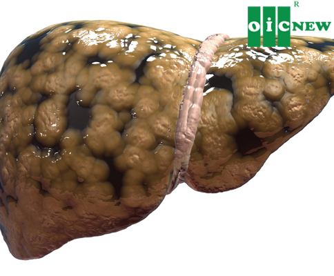 upload/files/GAN_MAT/fatty-liver-disease-main.jpg